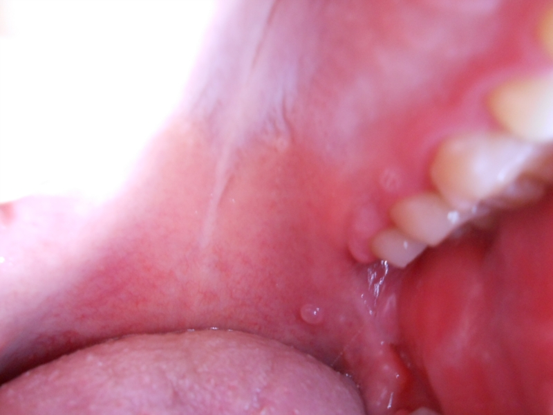 Cyst On Roof Of Mouth 37