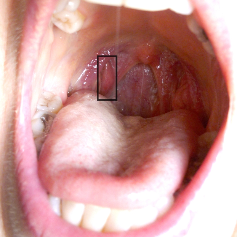 Left Side Of Throat Swollen 98