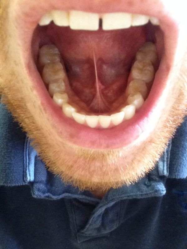 Bumps On Floor Of Mouth 54
