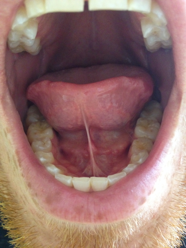 Bumps On Floor Of Mouth 38