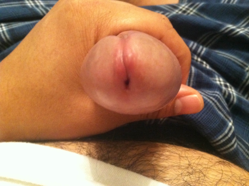 Swollen Penis 16
