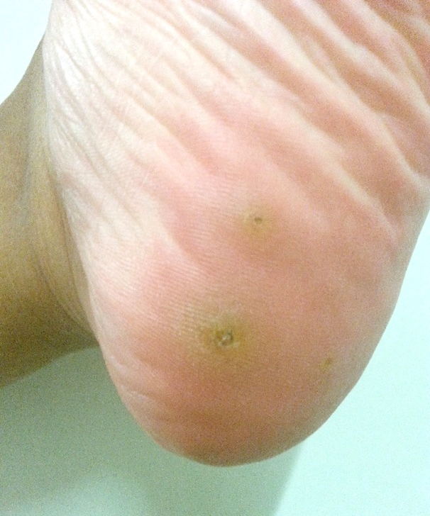 List 104 Pictures Psoriasis On Bottom Of Feet Pictures Latest