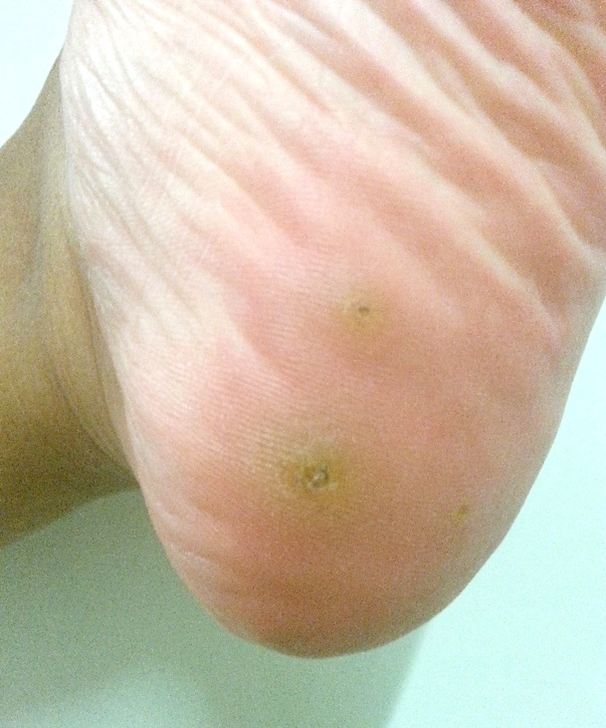 Little Painful Bumps On My Feet I Don t Know What Are Those Thread 