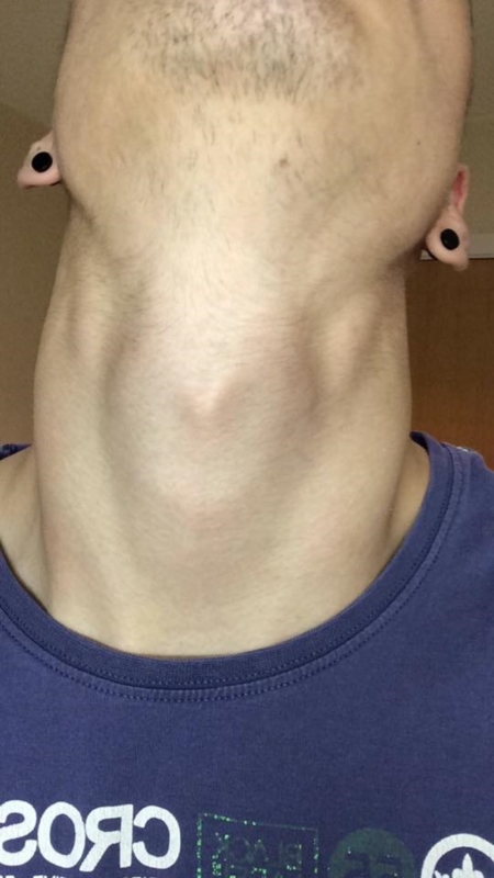 visible shotty lymph node in skinny neck