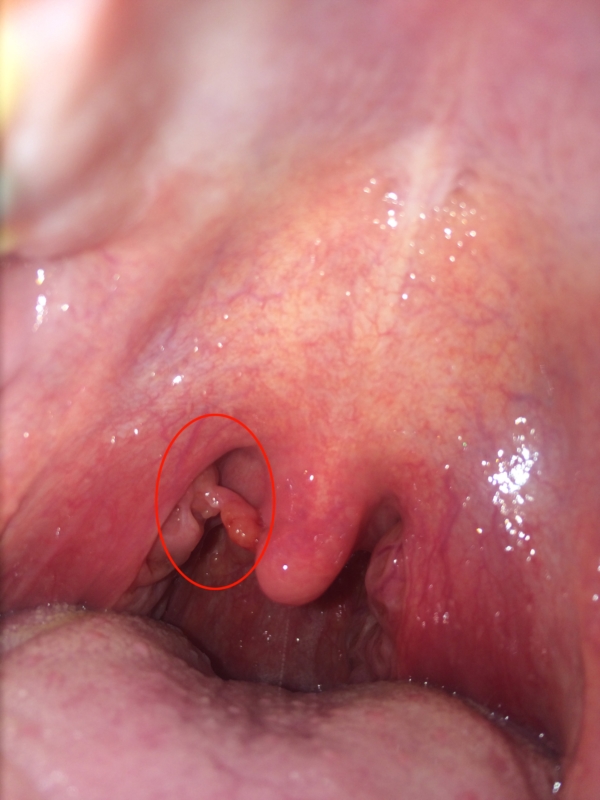Herpes in Throat - Buzzle