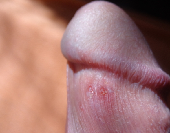 Lumps Bumps Cysts - Bridgeport, WV Dermatologist