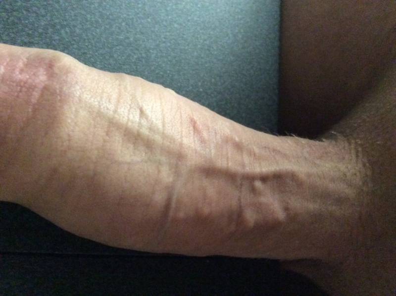 Bumps Under Skin Of Penis 17