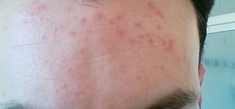 Can Someone Help Identify This Facial Rash Thread Discussing Can