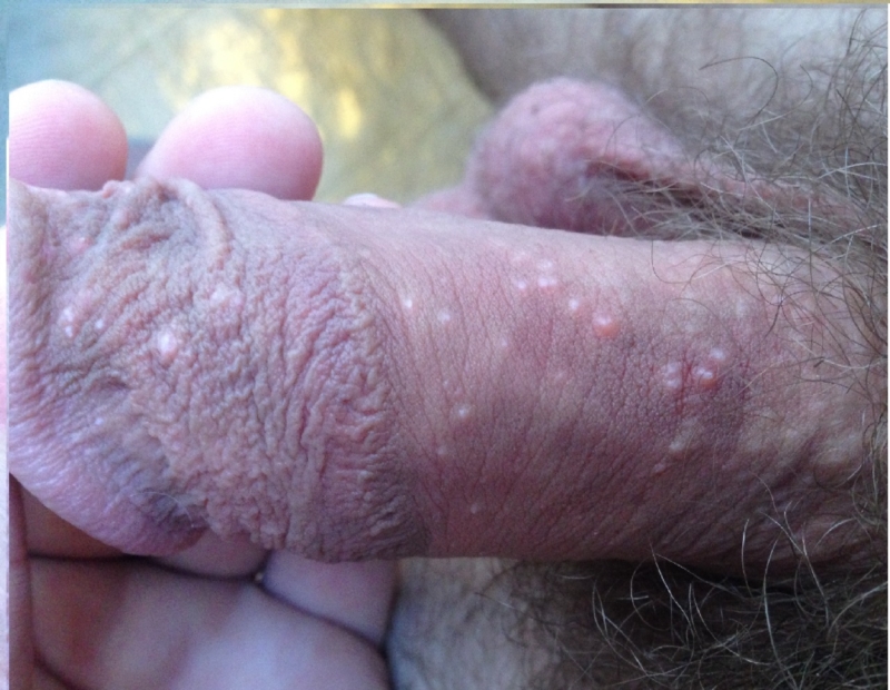 genital herpes on male #11