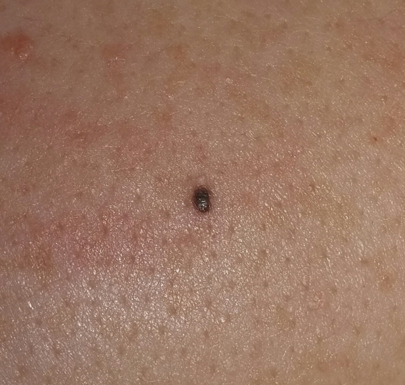 Small Black Spot On Penis 54