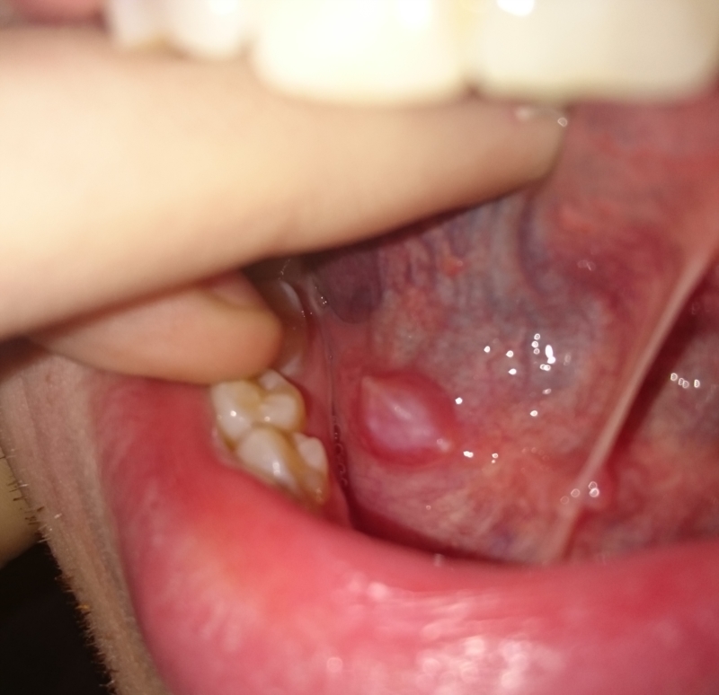 Black Lump In Mouth 91