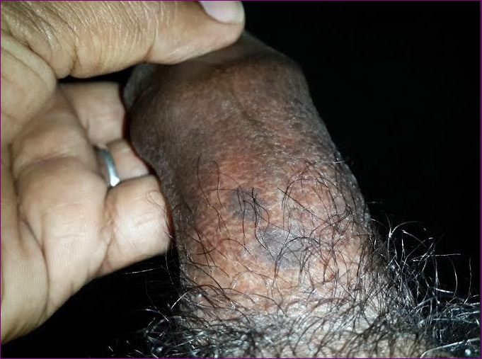 Pictures Of Red Spots On Penis 32