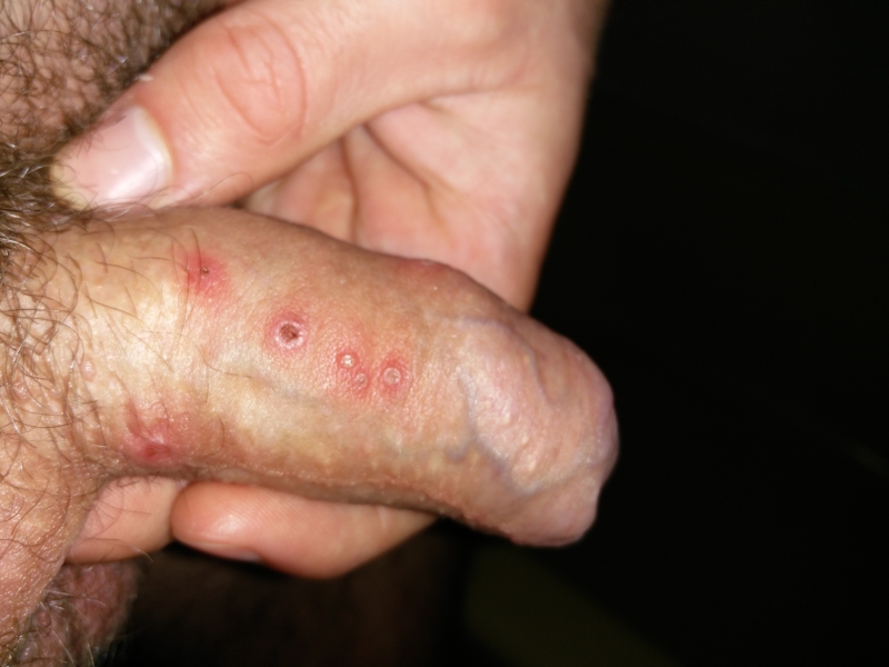 herpes blisters on penis