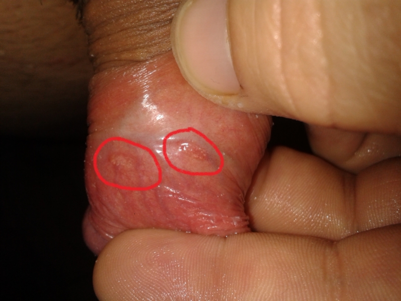 Tiny Red Bumps On Penis 42