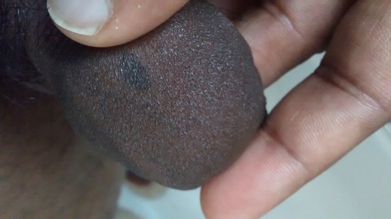 Head Of Penis Dry 17