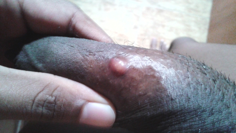 Cyst On The Penis 25