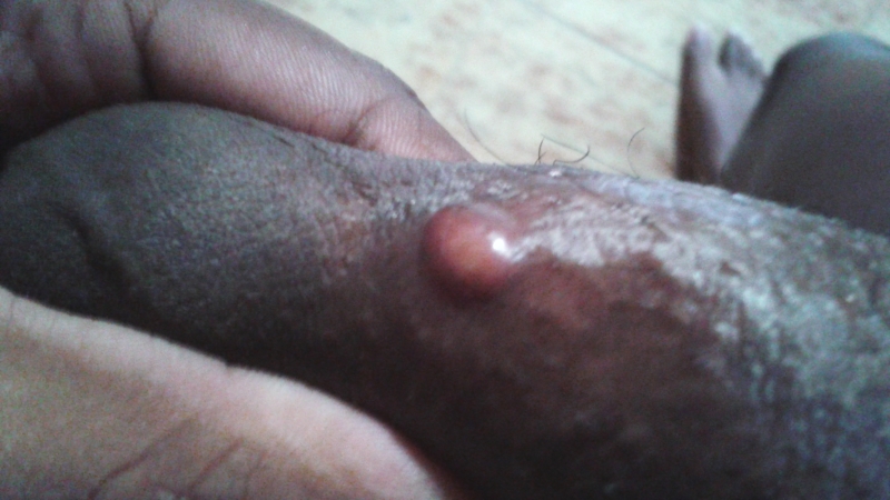 Lump On Tip Of Penis 49