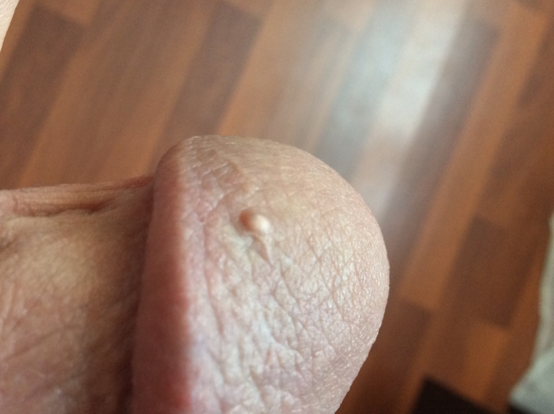 Small Bumps On Tip Of Penis 58