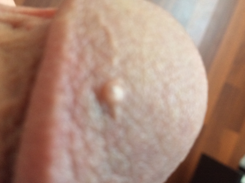 Small Bump On My Penis 84