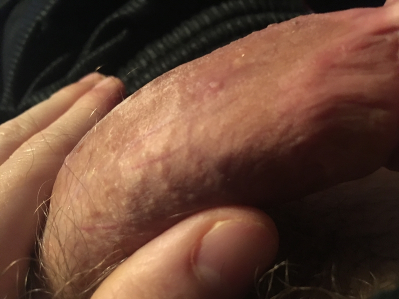 Small Pimple like Bumps On Penis - Dermatology - MedHelp