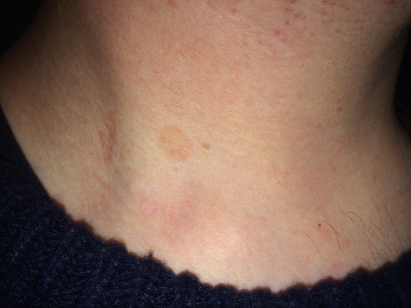 Dry Circles On Chestneck Thread Discussing Dry Circles On Chestneck