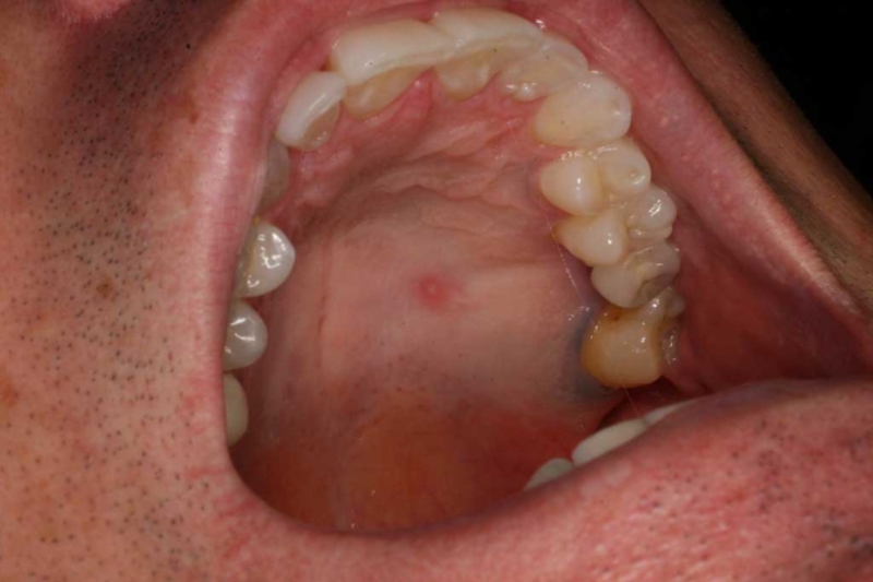 Lump Under Mouth 115