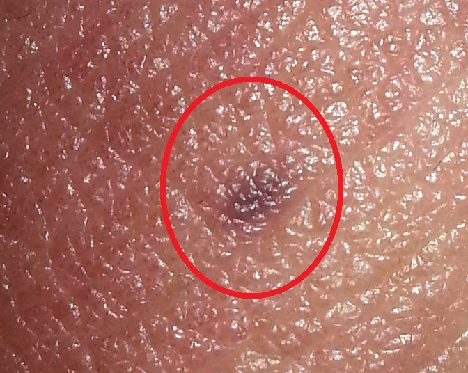 Red Spot On Tip Of Penis 38