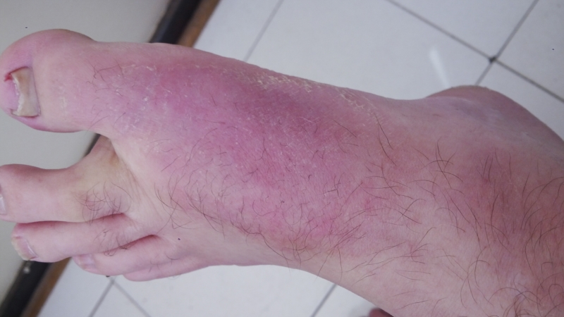 red-skin-condition-on-foot-pic-included-thread-discussing-red-skin