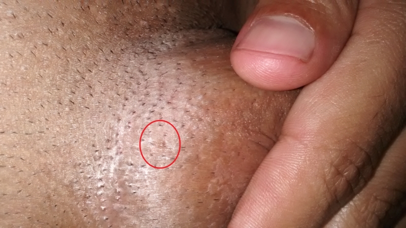 Common Wart in Adults: Condition, Treatments, and Pictures ...